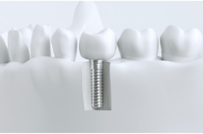 牙齿缺失，为什么选择种植牙？