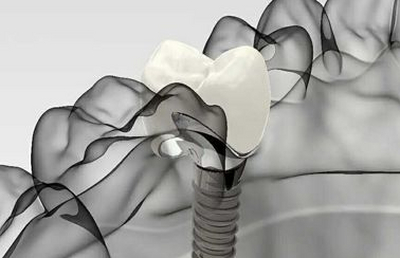 3D数字化种植牙，舒适种好牙