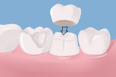 牙冠修复，为你解决牙齿侵蚀问题